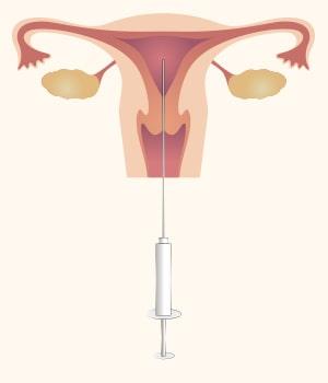 胚移植